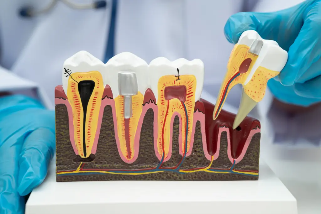 Implant-Supported Restorations at BeauDent Family Dental in Beaumont