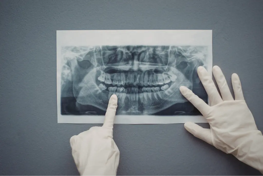 Replacing a Missing Tooth at BeauDent Family Dental in Beaumont