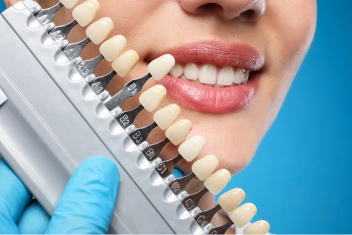 Dental Bonding at BeauDent Family Dental in Beaumont