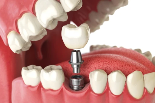 What Are Dental Implants? at BeauDent Family Dental in Beaumont